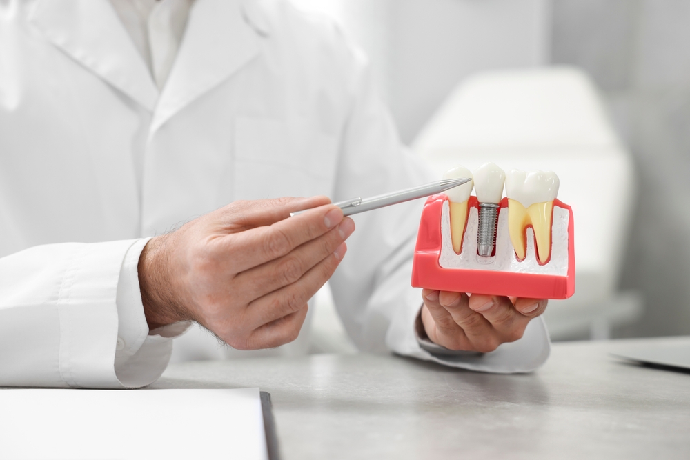 Doctor,Showing,Educational,Model,Of,Dental,Implant,In,Clinic,,Closeup